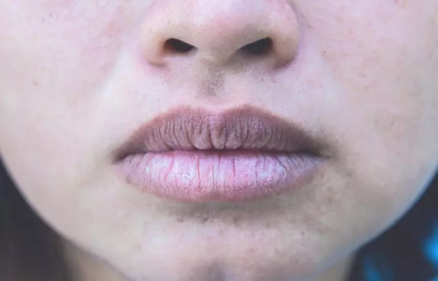 Say Goodbye to Dark Lips with These Dermatologist