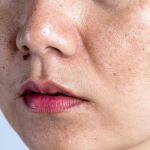 Dermatologist's Guide to Managing Open Pores Safely