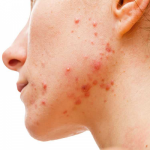 How Dermatologists Use Prescription Creams to Reduce Dark Spots